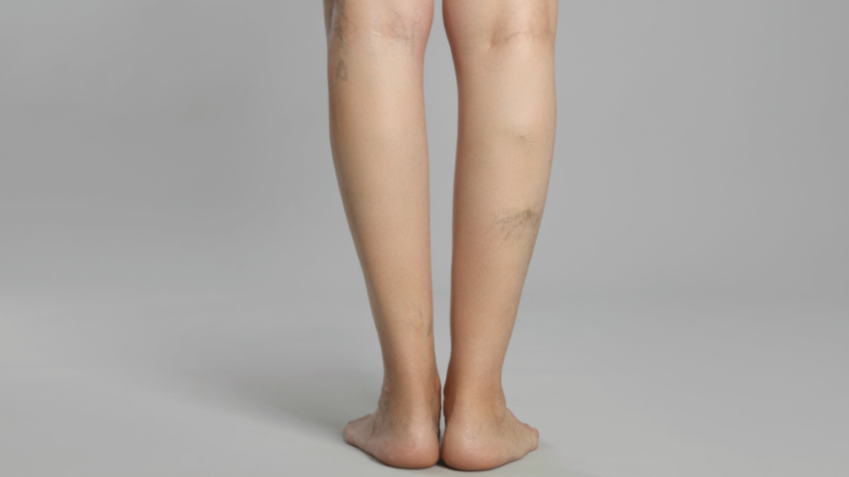 Lifestyle Tips for Preventing Varicose Veins