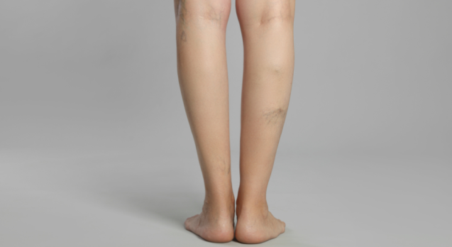 Lifestyle Tips for Preventing Varicose Veins